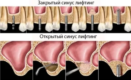 Кісткова пластика атрофія кісткової тканини, методи остеопластики (атрофія) Кісткова пластика атрофія кісткової тканини, методи остеопластики