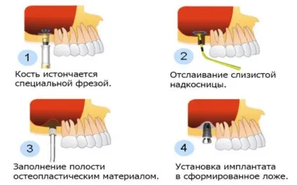 Кісткова пластика атрофія кісткової тканини, методи остеопластики (кісткова) Кісткова пластика атрофія кісткової тканини, методи остеопластики