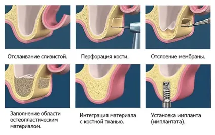 Кісткова пластика атрофія кісткової тканини, методи остеопластики (пластика) Кісткова пластика атрофія кісткової тканини, методи остеопластики