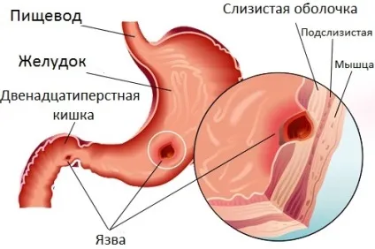 Кровотеча при виразці шлунка в чому небезпека і як лікувати