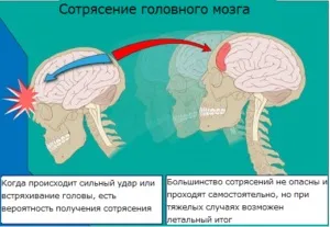 Струс головного мозку - лікування народними засобами (лікування) Струс головного мозку - лікування народними засобами