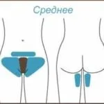 Лазерна епіляція особливості проведення процедури і використовувані матеріали (волосся зони бікіні) Лазерна епіляція особливості проведення процедури і використовувані матеріали