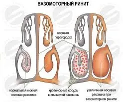 Лікування лор захворювань (тонзиліту, риніту, гаймориту) лазером (лазером) Лікування лор захворювань (тонзиліту, риніту, гаймориту) лазером