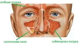 Лікування лор захворювань (тонзиліту, риніту, гаймориту) лазером (риніту) Лікування лор захворювань (тонзиліту, риніту, гаймориту) лазером