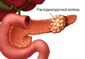 Лікування раку підшлункової залози - хіміотерапія, знеболюючі