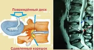 Лікування протрузії міжхребцевих дисків в домашніх умовах (міжхребцевих) Лікування протрузії міжхребцевих дисків в домашніх умовах