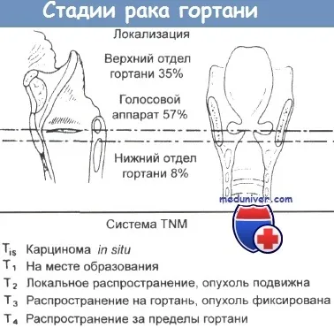 Лікування раку гортані і їх перспективи (хворих на рак гортані) Лікування раку гортані і їх перспективи