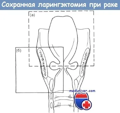 Лікування раку гортані і їх перспективи (перспективи лікування раку гортані) Лікування раку гортані і їх перспективи
