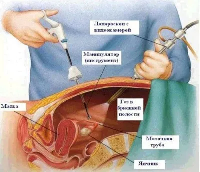 Лапароскопія кісти яєчника операція і післяопераційний період (післяопераційний) Лапароскопія кісти яєчника операція і післяопераційний період