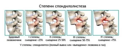 Лікування люмбалгии поперекового відділу хребта