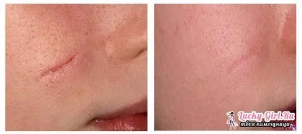 Лазерна шліфовка особи відгуки (лазерне шліфування особи відгуки) Лазерна шліфовка особи відгуки