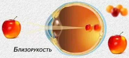 Лікування міопії слабкого ступеня (лікування) Лікування міопії слабкого ступеня