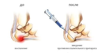 Лікування остеофитов на п'ятах народними засобами