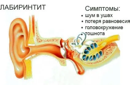 Лабіринтит - причини, ознаки, симптоми і лікування (лабіринтит запалення внутрішнє вухо інфекція отит причини симптоми лікування вестибулярний апарат) Лабіринтит - причини, ознаки, симптоми і лікування