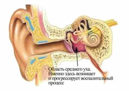 Лабіринтит - причини, ознаки, симптоми і лікування (лабіринтит) Лабіринтит - причини, ознаки, симптоми і лікування