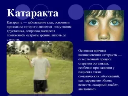 Лікування катаракти народними засобами, відгуки вилікувалися (краплі) Лікування катаракти народними засобами, відгуки вилікувалися