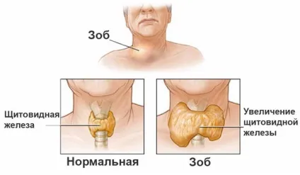 Лікування зобу щитовидної залози народними засобами (засобами) Лікування зобу щитовидної залози народними засобами