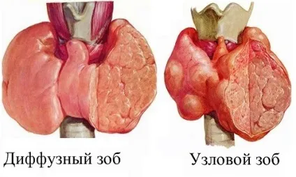 Лікування зобу щитовидної залози народними засобами (щитовидної) Лікування зобу щитовидної залози народними засобами