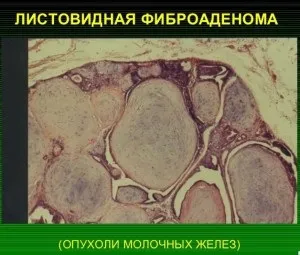 Листоподібна фіброаденома молочної залози фото захворювання (молочної) Листоподібна фіброаденома молочної залози фото захворювання