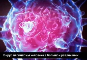 Листоподібна фіброаденома молочної залози фото захворювання (листоподібна фіброаденома молочної залози) Листоподібна фіброаденома молочної залози фото захворювання