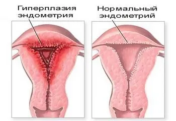 Листоподібна фіброаденома молочної залози фото захворювання (листоподібна) Листоподібна фіброаденома молочної залози фото захворювання