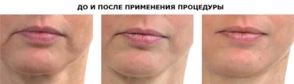 Lpg масаж обличчя що це таке, показання, протипоказання, етапи (масаж) Lpg масаж обличчя що це таке, показання, протипоказання, етапи