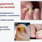 Мідний купорос від грибка нігтів інструкція та відгуки (купорос) Мідний купорос від грибка нігтів інструкція та відгуки