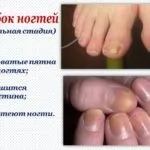 Мідний купорос від грибка нігтів інструкція та відгуки (мідний) Мідний купорос від грибка нігтів інструкція та відгуки