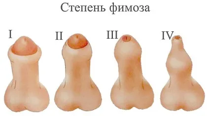 Мазі для лікування фімозу у дорослих чоловіків (лікування) Мазі для лікування фімозу у дорослих чоловіків