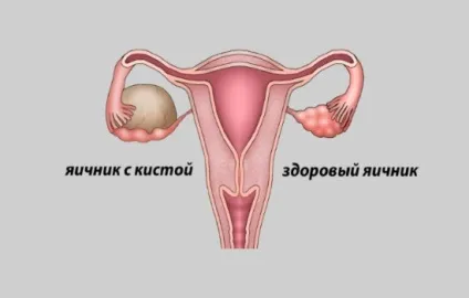 Місячні після лапароскопії чому їх немає (лапароскопії) Місячні після лапароскопії чому їх немає