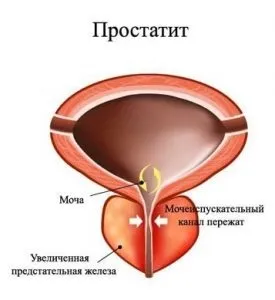 Союз Аполлон прилад для лікування передміхурової залози у чоловіків (лікування) Союз Аполлон прилад для лікування передміхурової залози у чоловіків