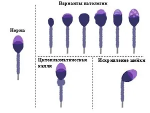 Сперматозоїди малорухливі причини і методи лікування (сперматозоїди) Сперматозоїди малорухливі причини і методи лікування
