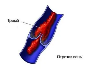 Союз Аполлон прилад для лікування передміхурової залози у чоловіків (Аполлон) Союз Аполлон прилад для лікування передміхурової залози у чоловіків