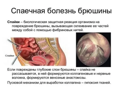 Спайки кишечника (спайкова хвороба) - симптоми і лікування, фото і відео