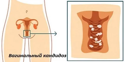 Молочниця при вагітності лікування в домашніх умовах народними засобами (молочниця) Молочниця при вагітності лікування в домашніх умовах народними засобами
