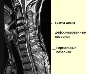 Мрт хребта що показує, як проходить процедура (показує) Мрт хребта що показує, як проходить процедура