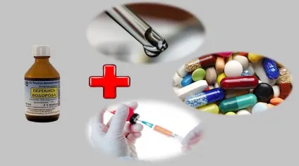 Чи можна капати перекис водню в вухо при отиті і ефективність лікування (водню) Чи можна капати перекис водню в вухо при отиті і ефективність лікування