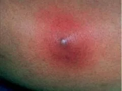 Нариви на ногах