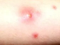 Нариви на ногах