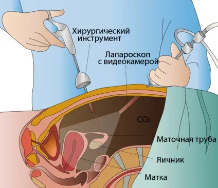 На який день знімають шви після лапароскопії особливості та догляд за ранами (особливості) На який день знімають шви після лапароскопії особливості та догляд за ранами