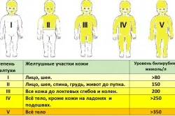 Неонатальна жовтяниця новонароджених класифікація, лікування (жовтяниця) Неонатальна жовтяниця новонароджених класифікація, лікування
