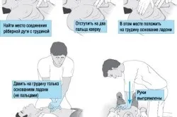 Непрямий масаж серця