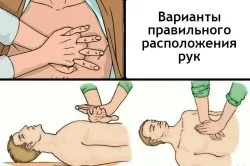 Непрямий масаж серця