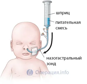 Назогастральний зонд постановка, годування, догляд (постановка) Назогастральний зонд постановка, годування, догляд