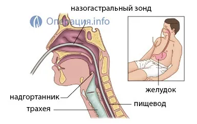Назогастральний зонд постановка, годування, догляд (постановка) Назогастральний зонд постановка, годування, догляд