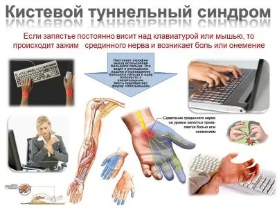 Чи не згинається палець на руці причини, що робити (причини) Чи не згинається палець на руці причини, що робити
