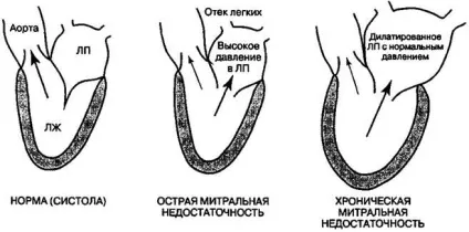 Недостатність мітрального клапана 1, 2, 3 і 4 ступеня лікування, прогноз, симптоми (недостатність мітрального клапана діагностика) Недостатність мітрального клапана 1, 2, 3 і 4 ступеня лікування, прогноз, симптоми