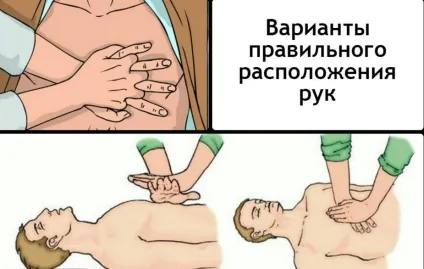 Непрямий масаж серця і штучне дихання (непрямого масажу серця) Непрямий масаж серця і штучне дихання