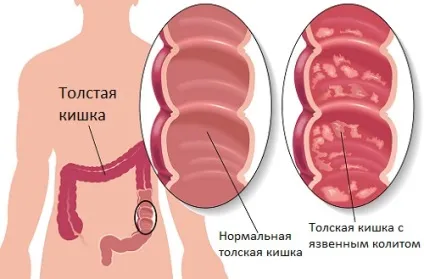 Но-шпа при панкреатиті яка дозування і мета застосування (мета) Но-шпа при панкреатиті яка дозування і мета застосування