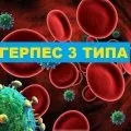 Оперізуючий лишай це герпес, вірус герпес (як підняти імунітет після оперізувального герпесу) Оперізуючий лишай це герпес, вірус герпес